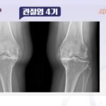 무릅 인공관절 수술 없이 100세까지 내 무릎 지키는 법